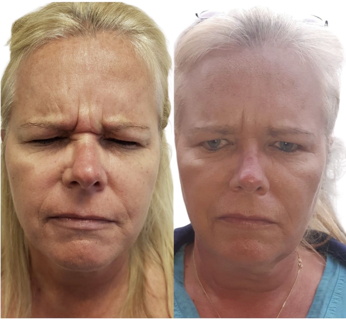 Before and after anti-wrinkle