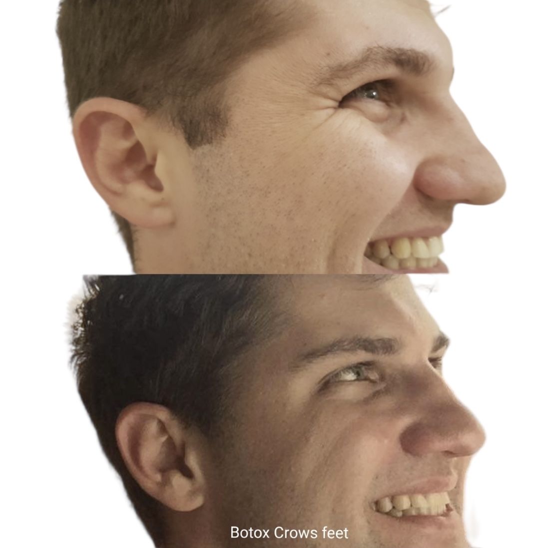 Before and after anti-wrinkle