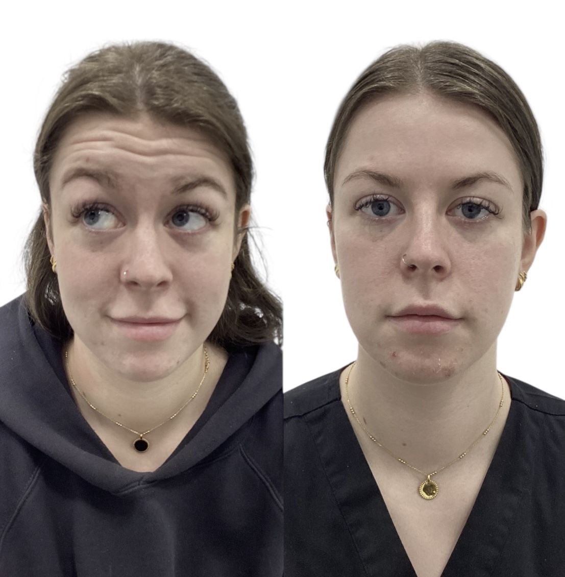 Before and after anti-wrinkle