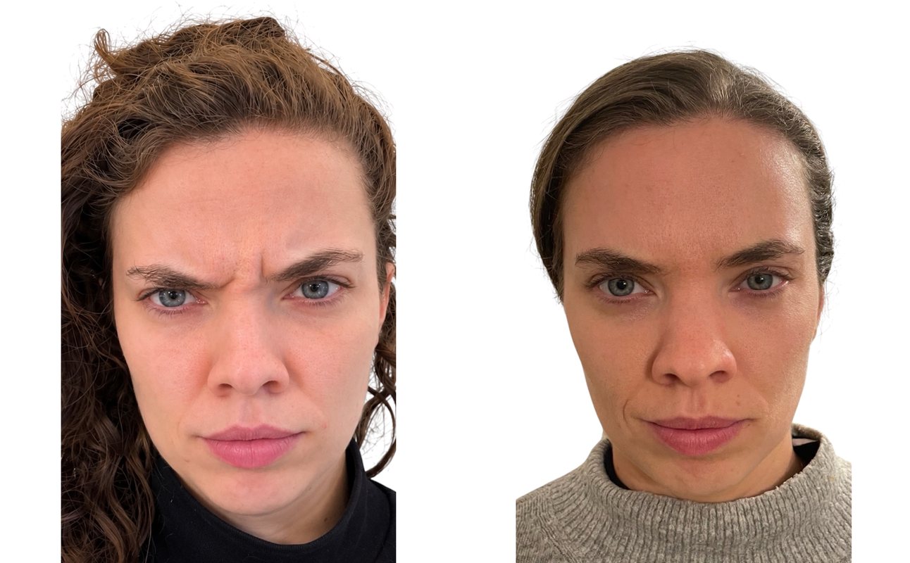 Before and after anti-wrinkle