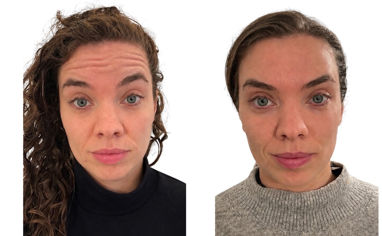 Before and after anti-wrinkle