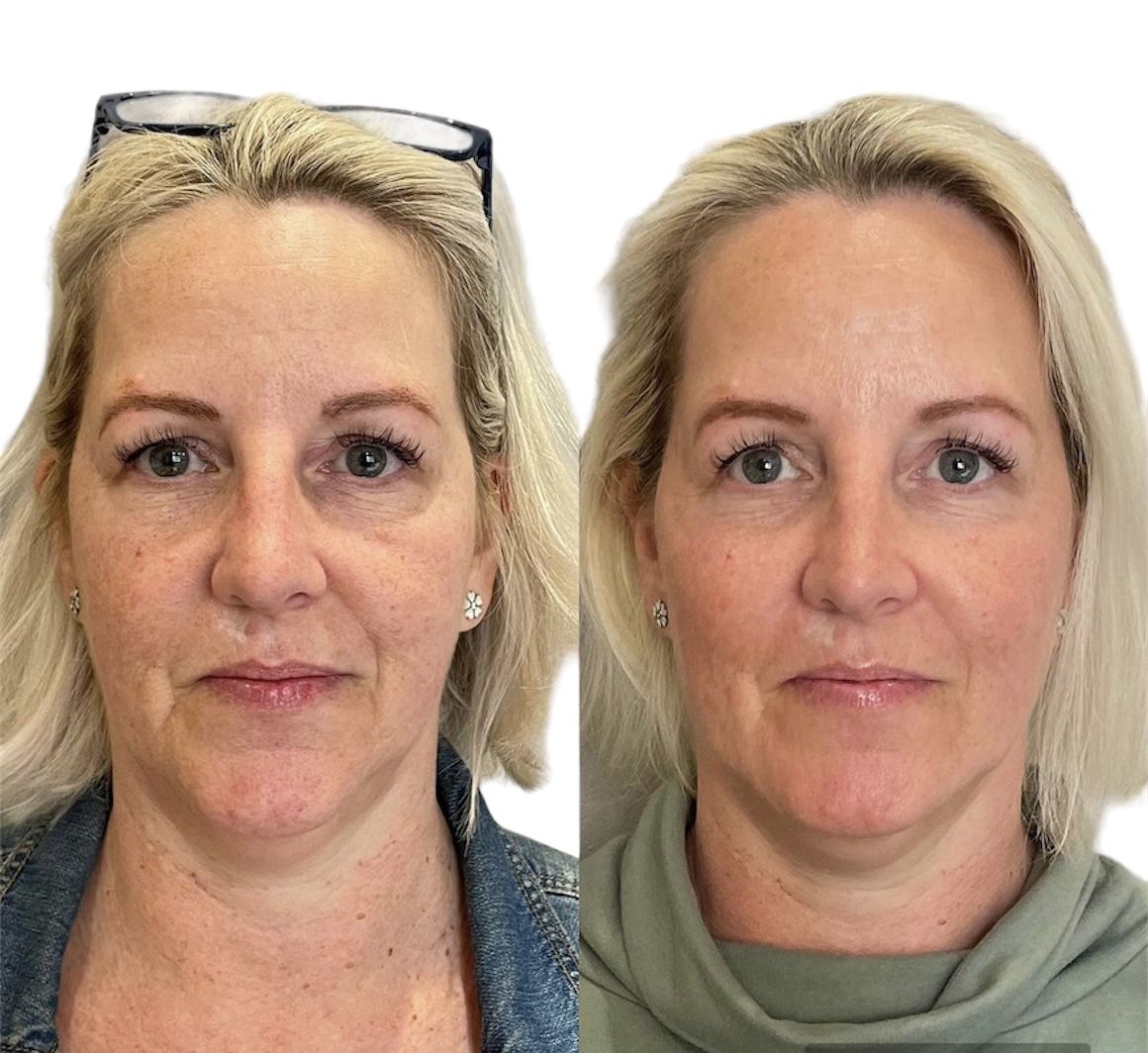 Before and after beautification