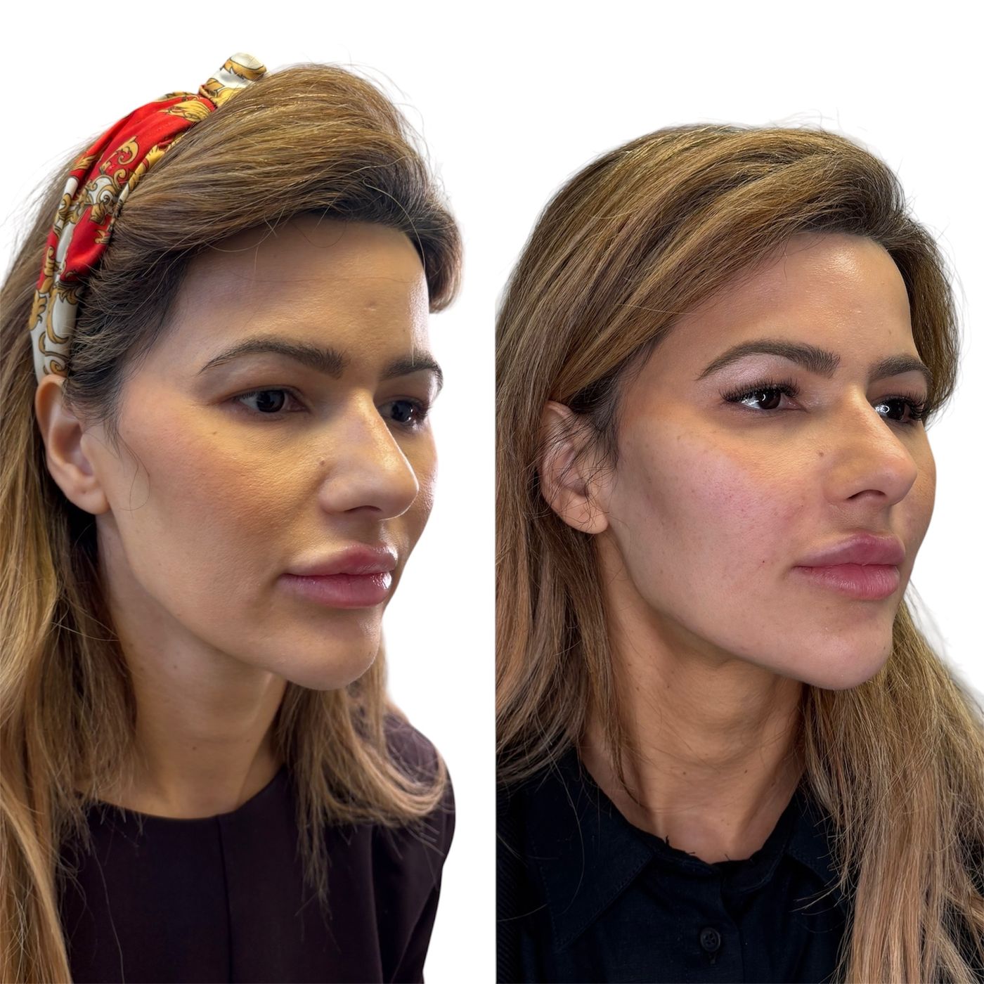 Before and after beautification
