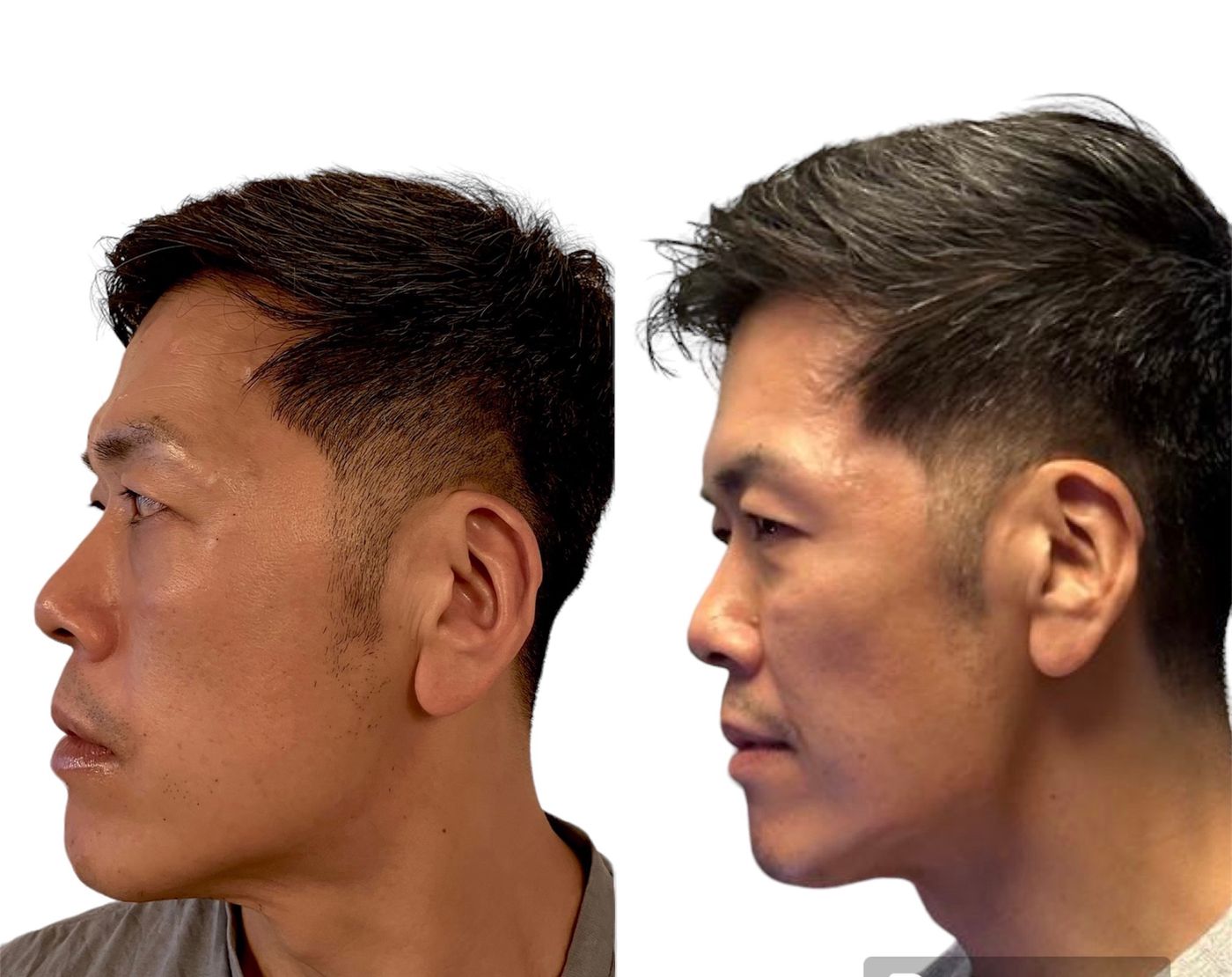 Before and after cheeks