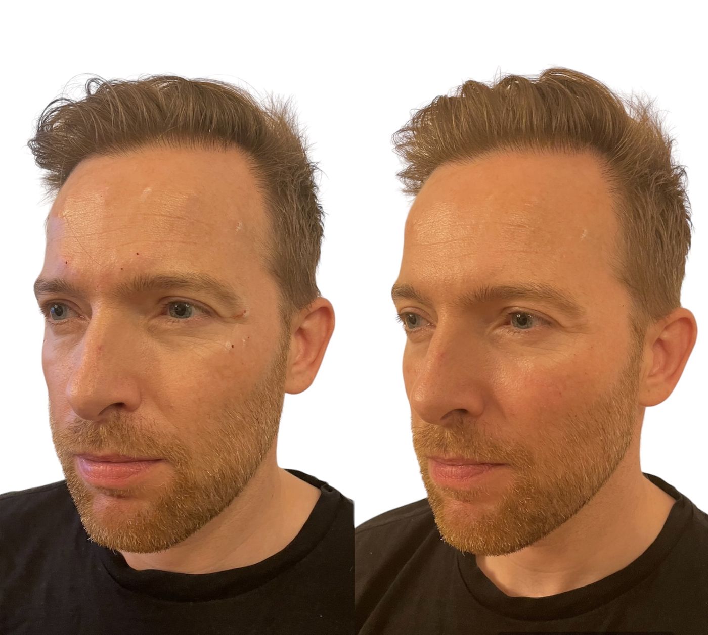 Before and after cheeks
