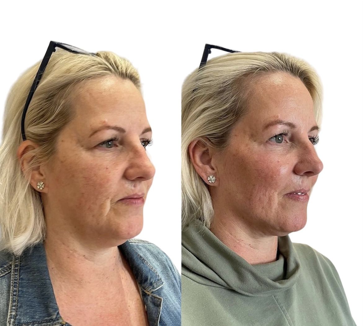 Before and after cheeks