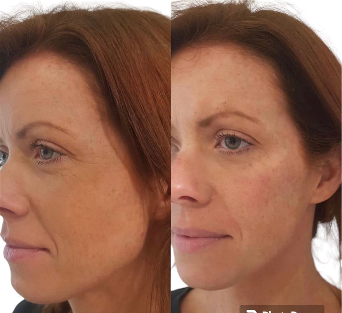 Before and after cheeks
