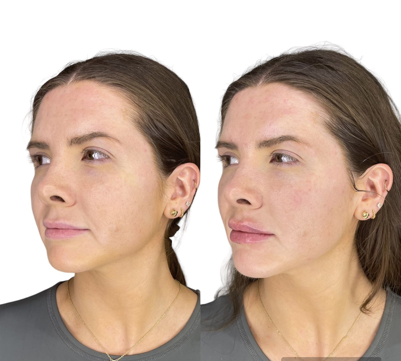 Before and after cheeks
