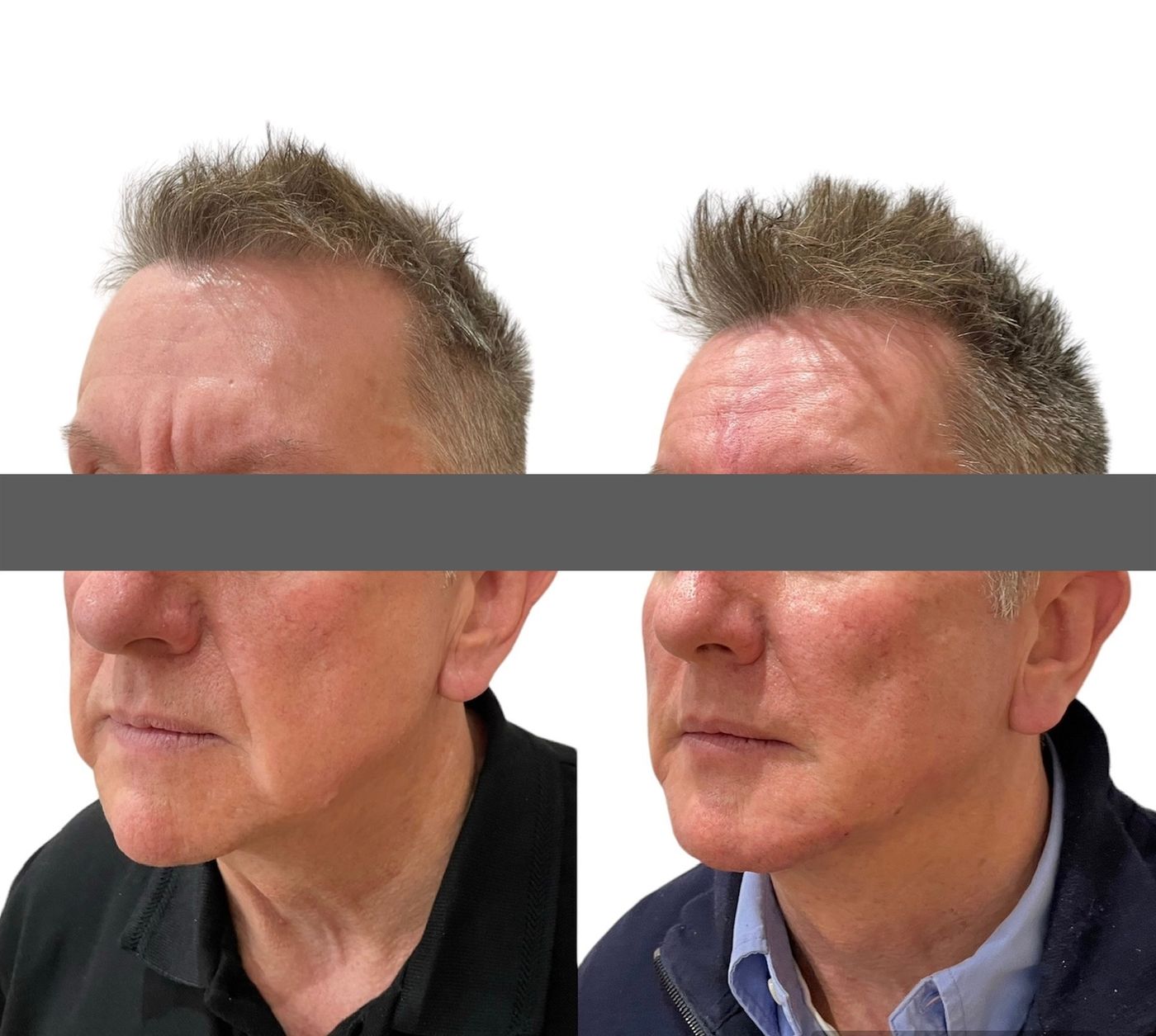 Before and after cheeks