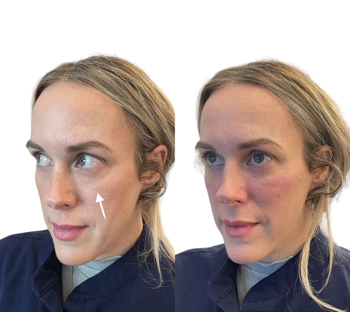 Before and after cheeks