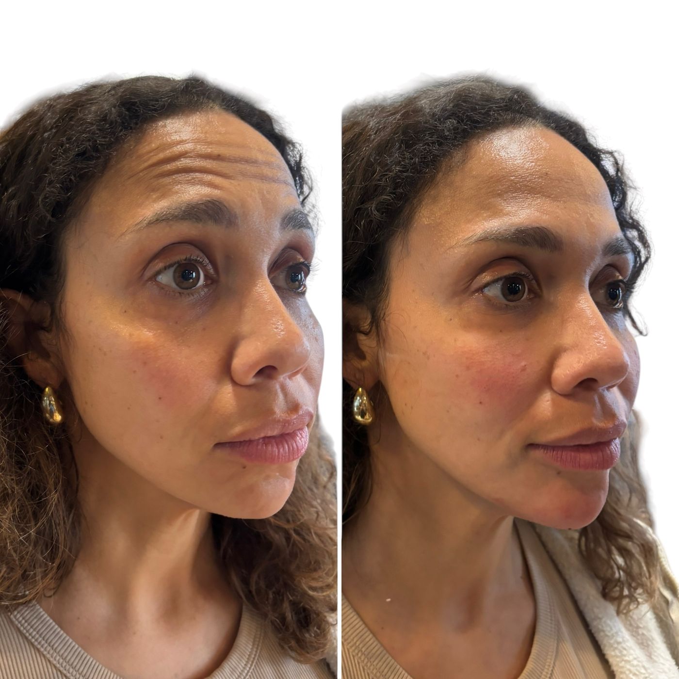 Before and after cheeks