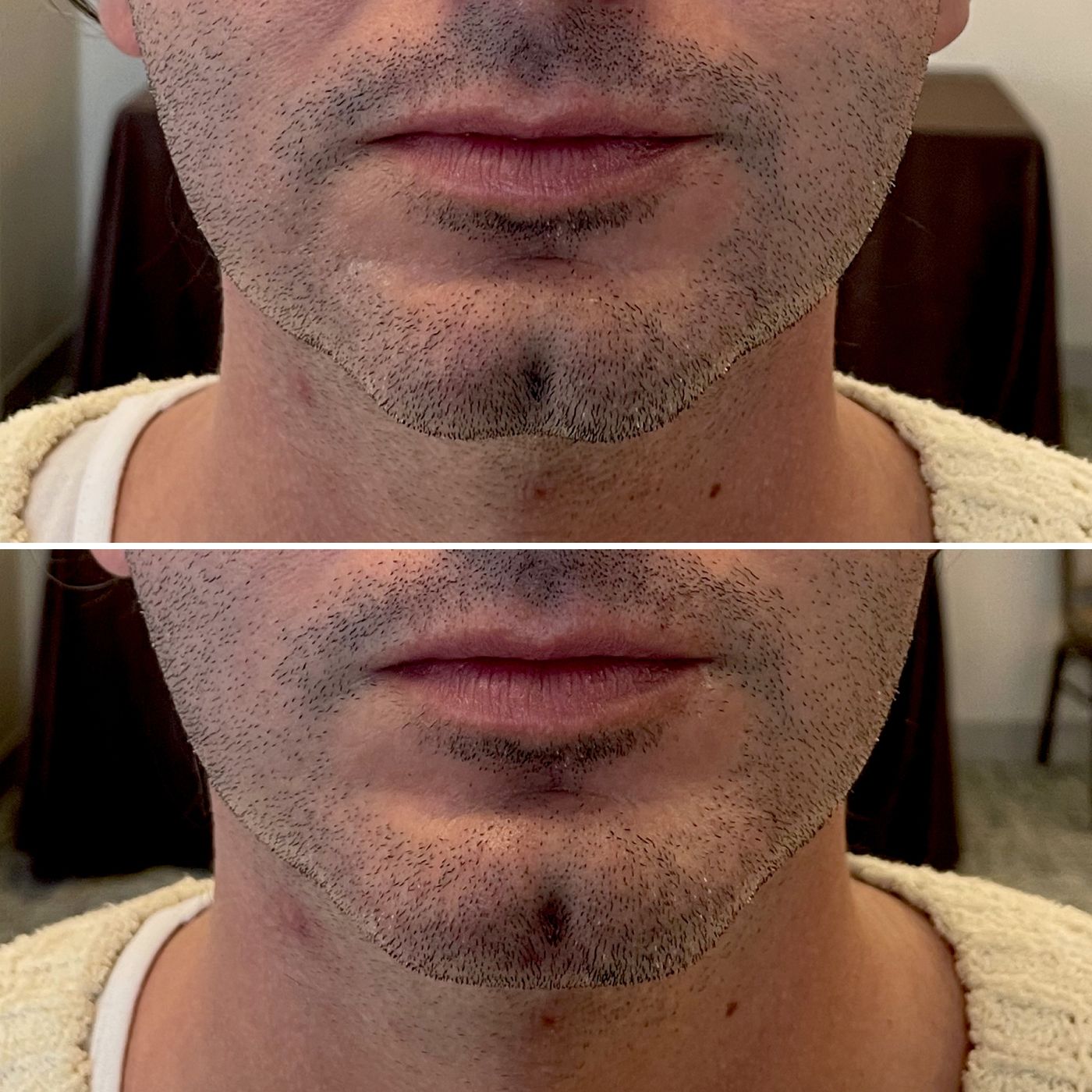 Before and after chin and jawline
