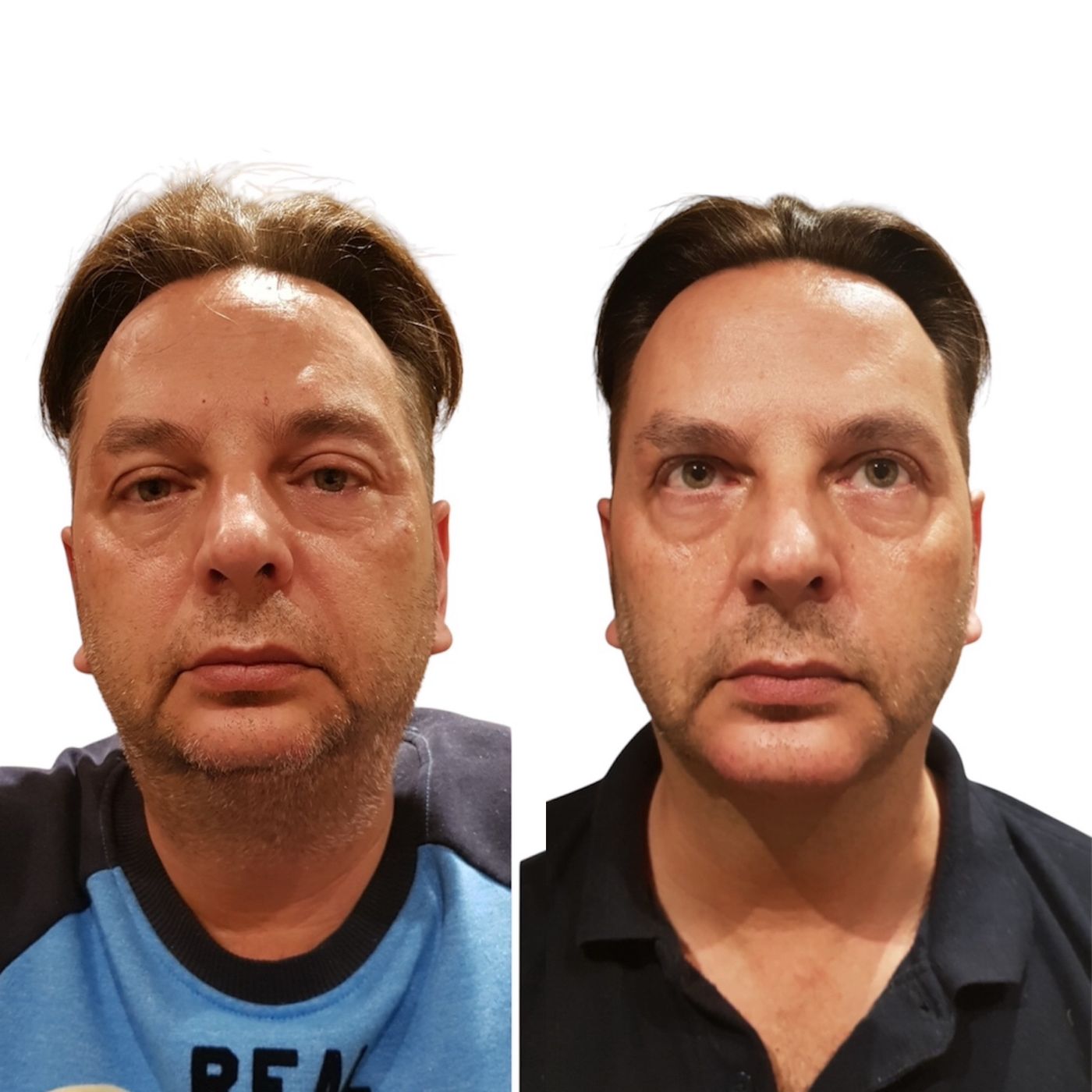 Before and after chin and jawline