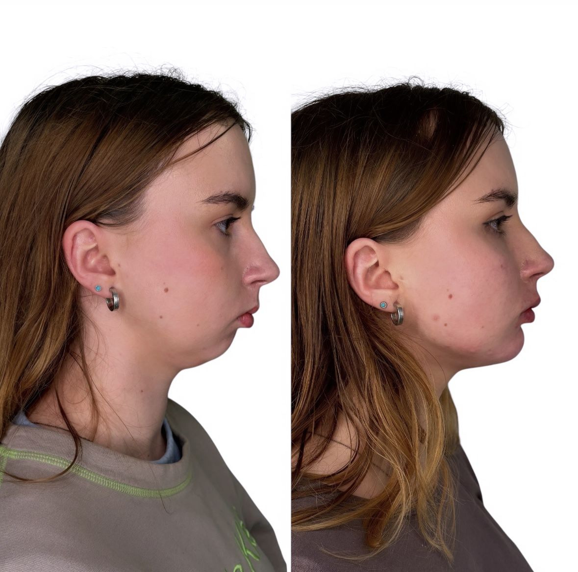 Before and after chin and jawline