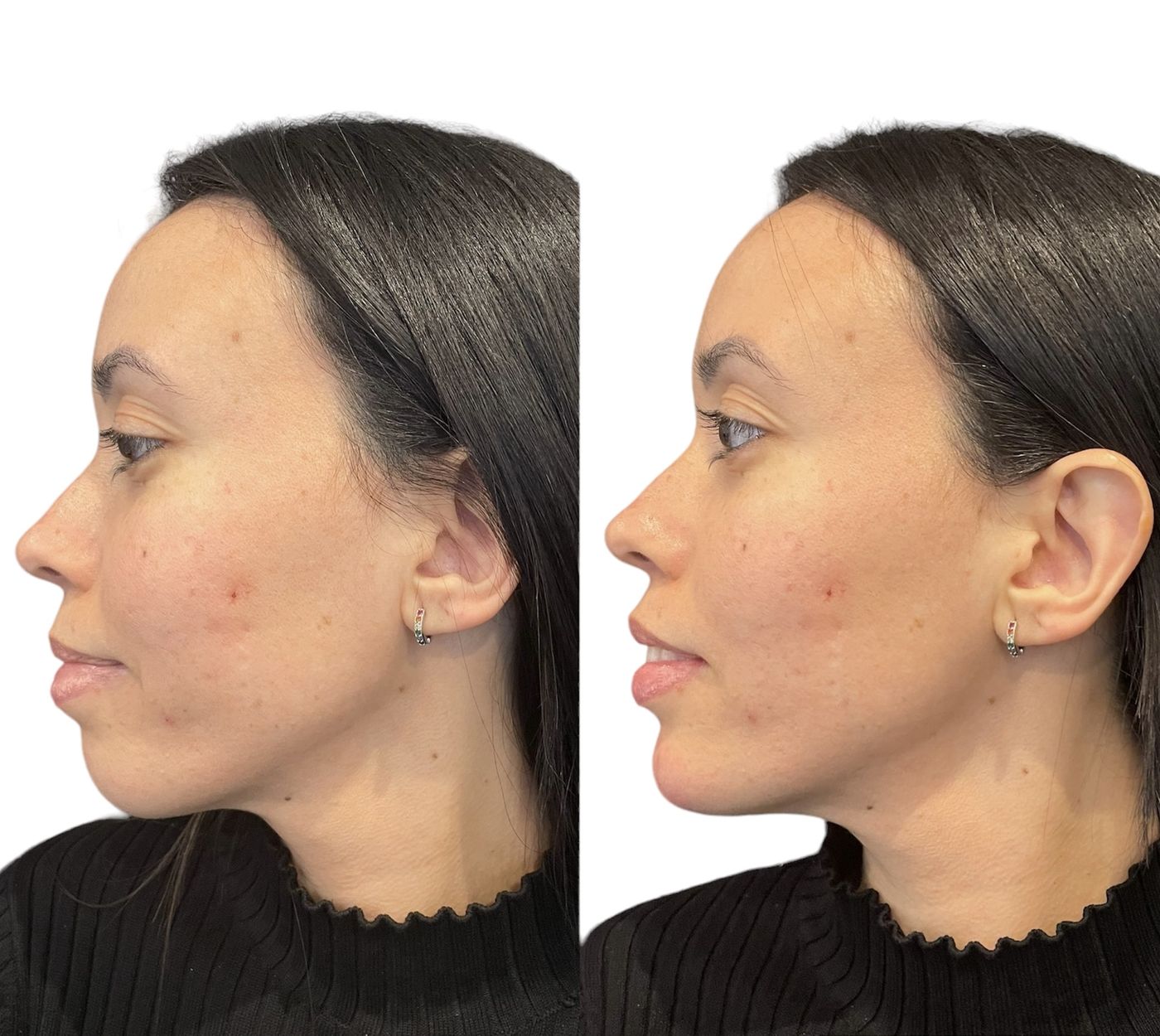 Before and after chin and jawline