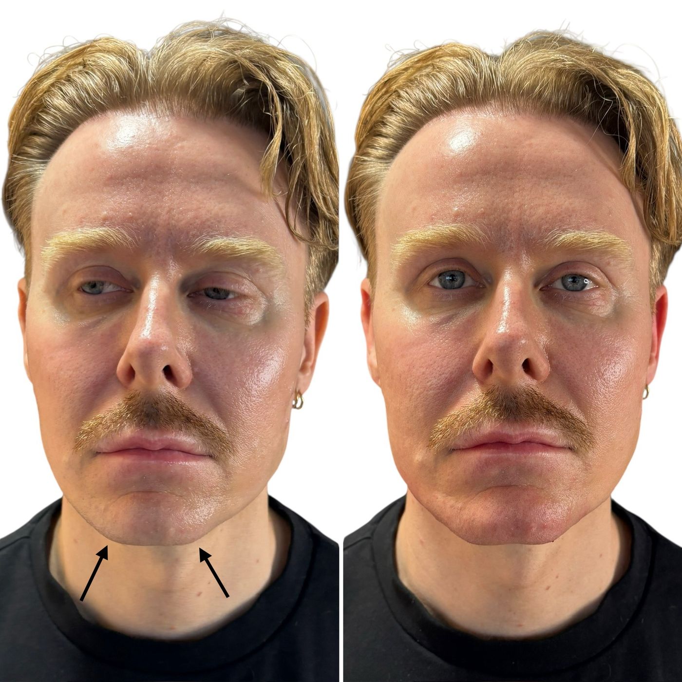 Before and after chin and jawline