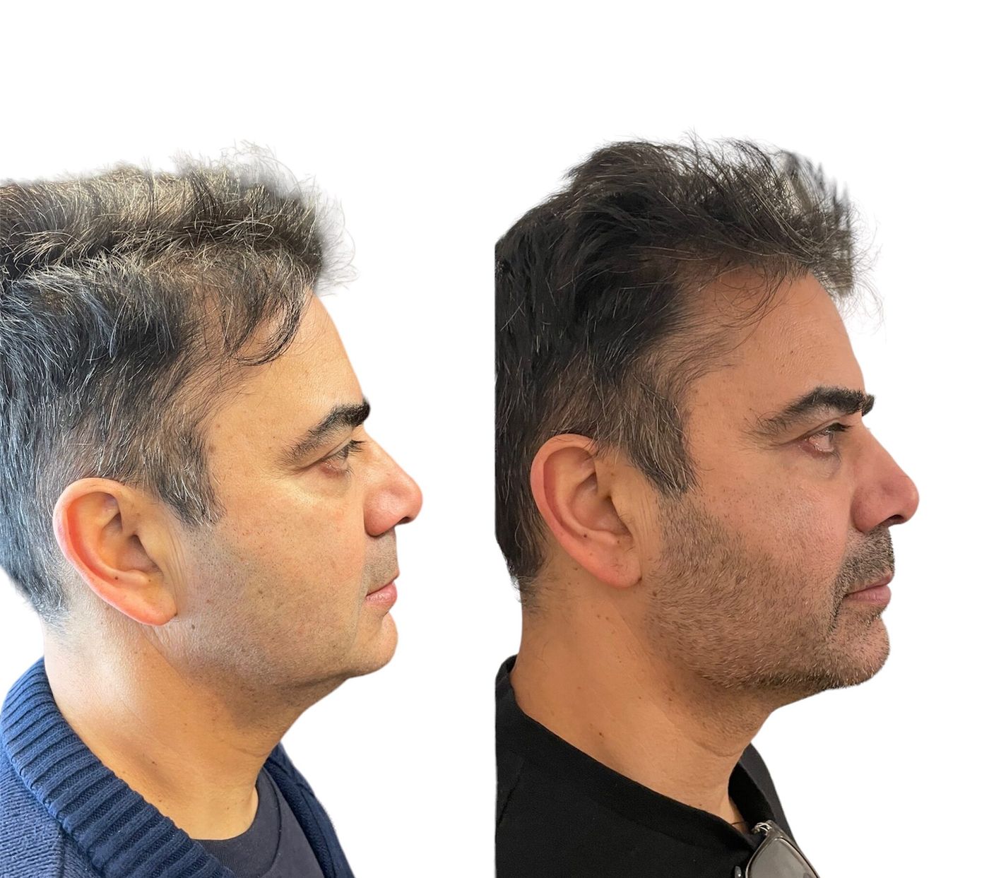 Before and after chin and jawline