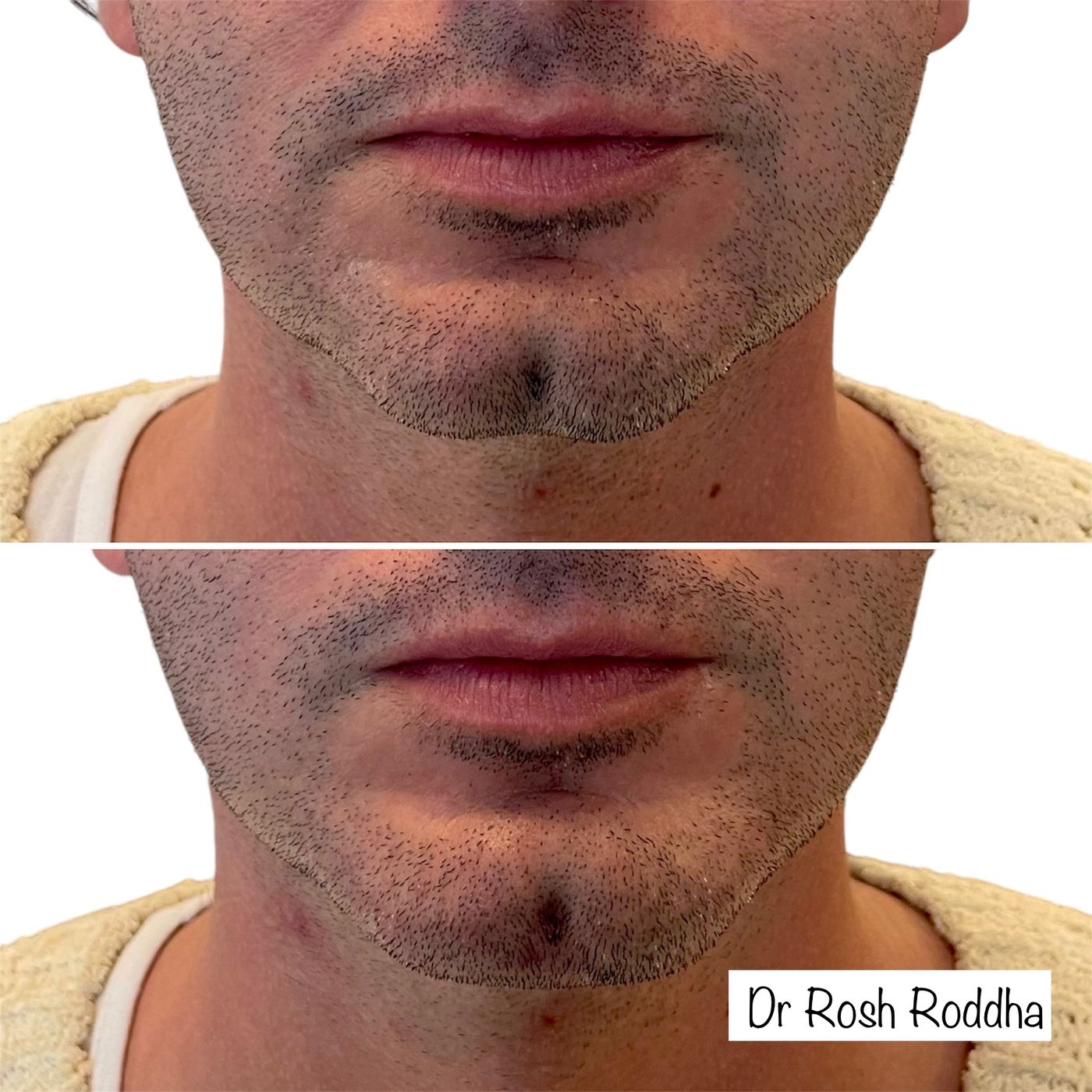 Before and after chin and jawline