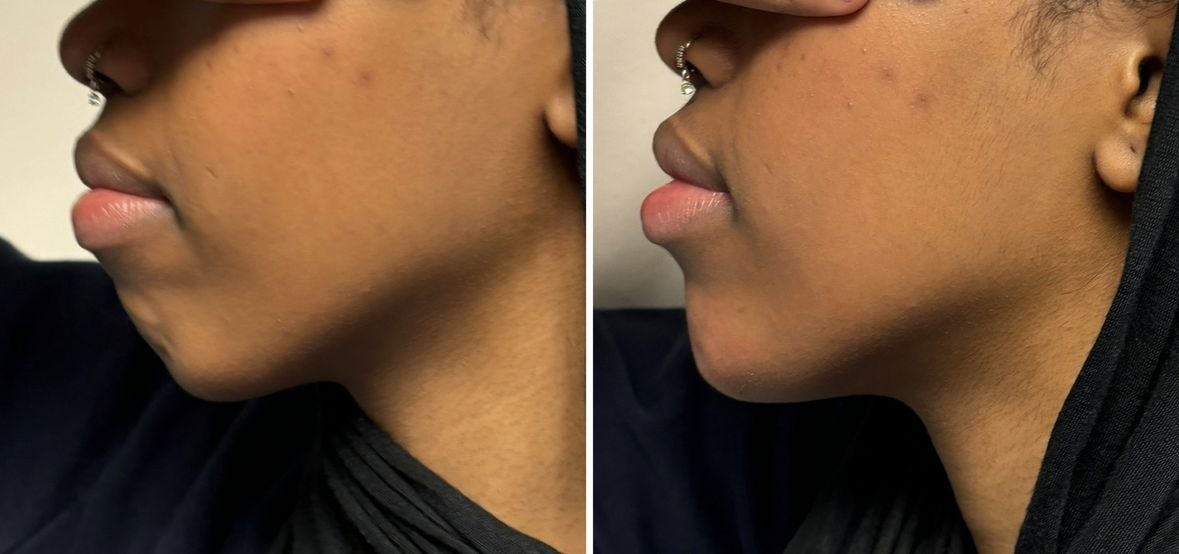 Before and after chin and jawline