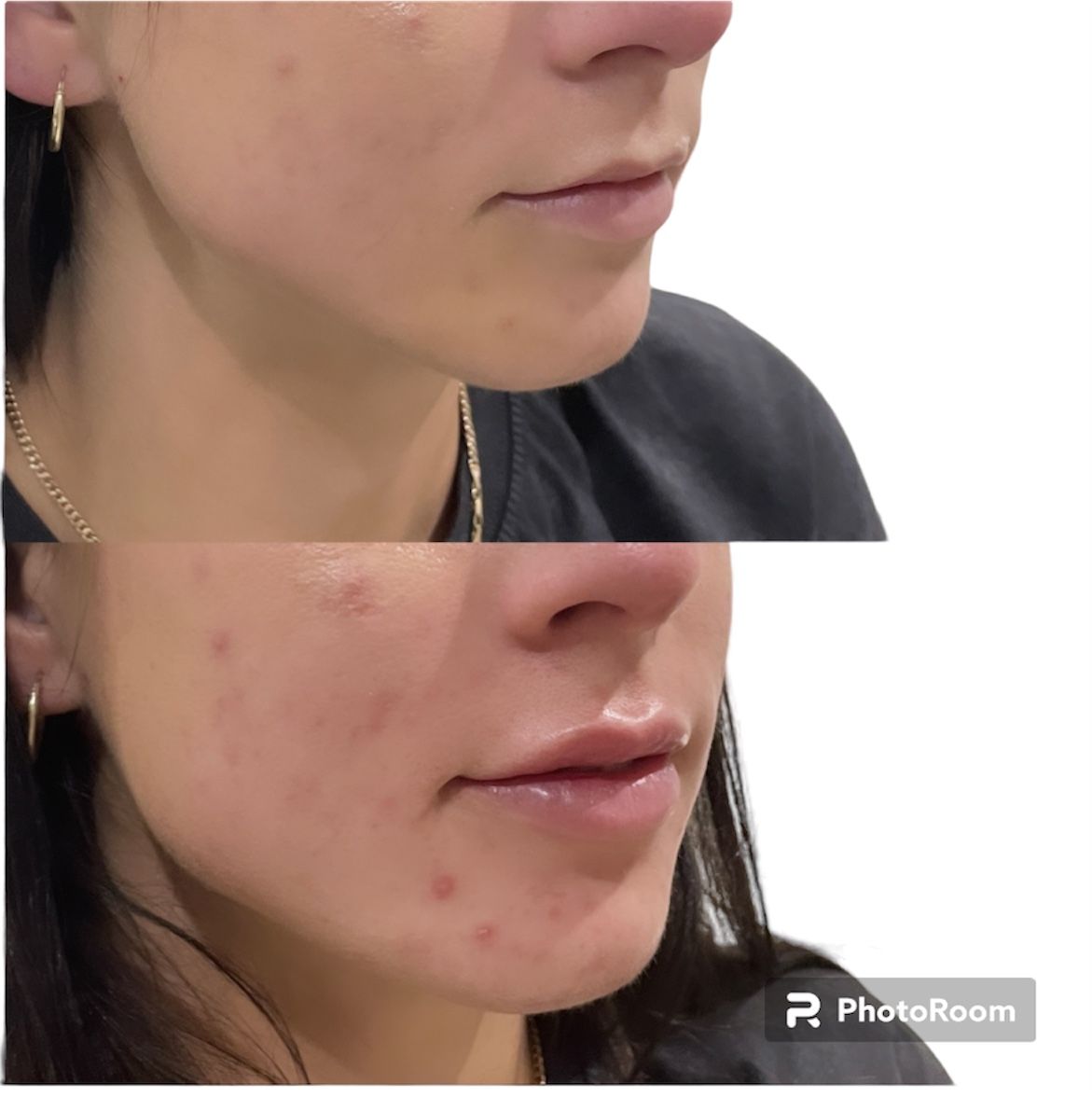Before and after lips