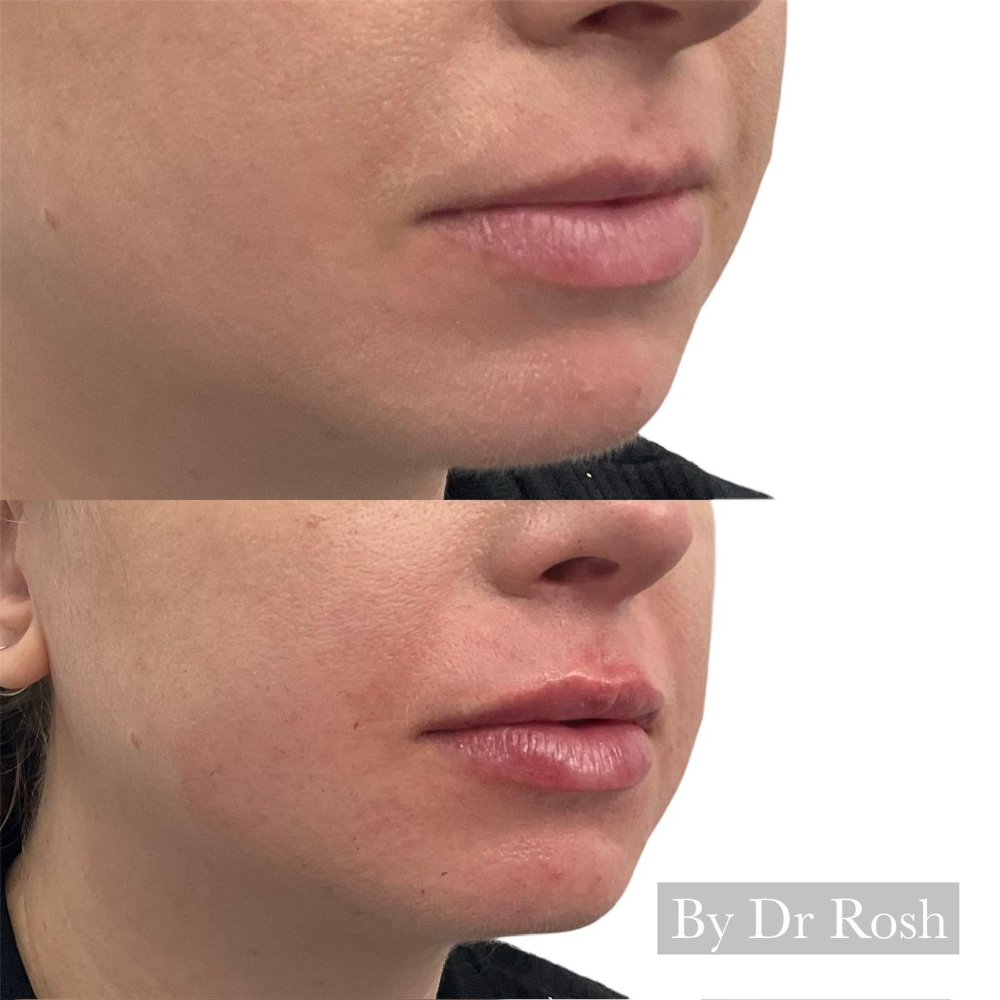 Before and after lips