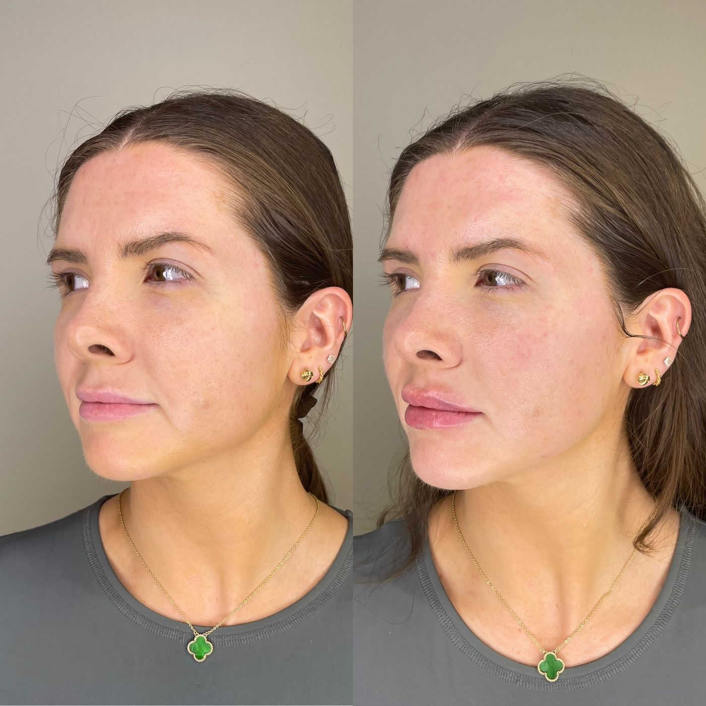 Before and after lips