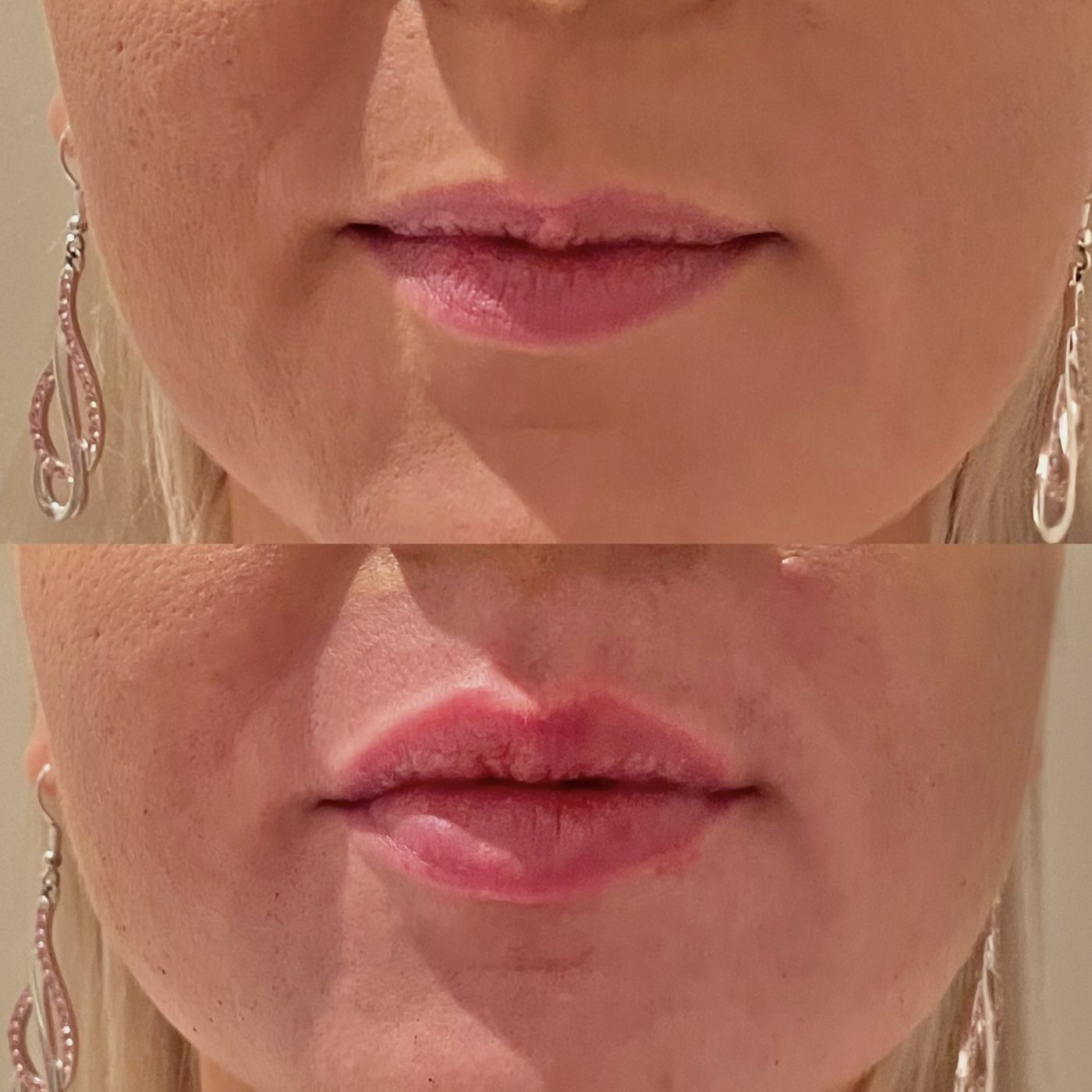 Before and after lips