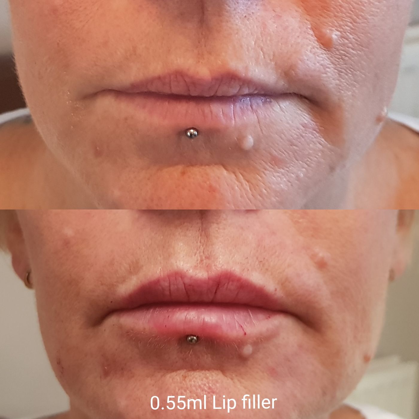 Before and after lips