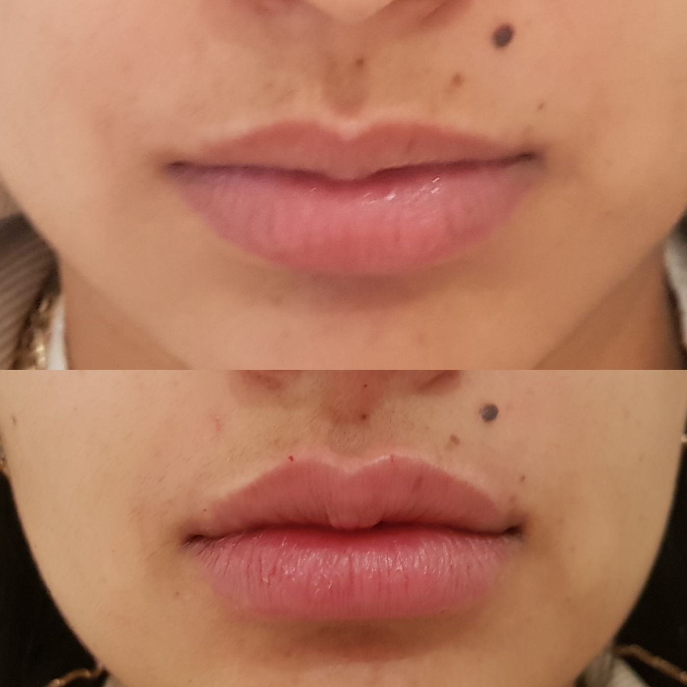 Before and after lips