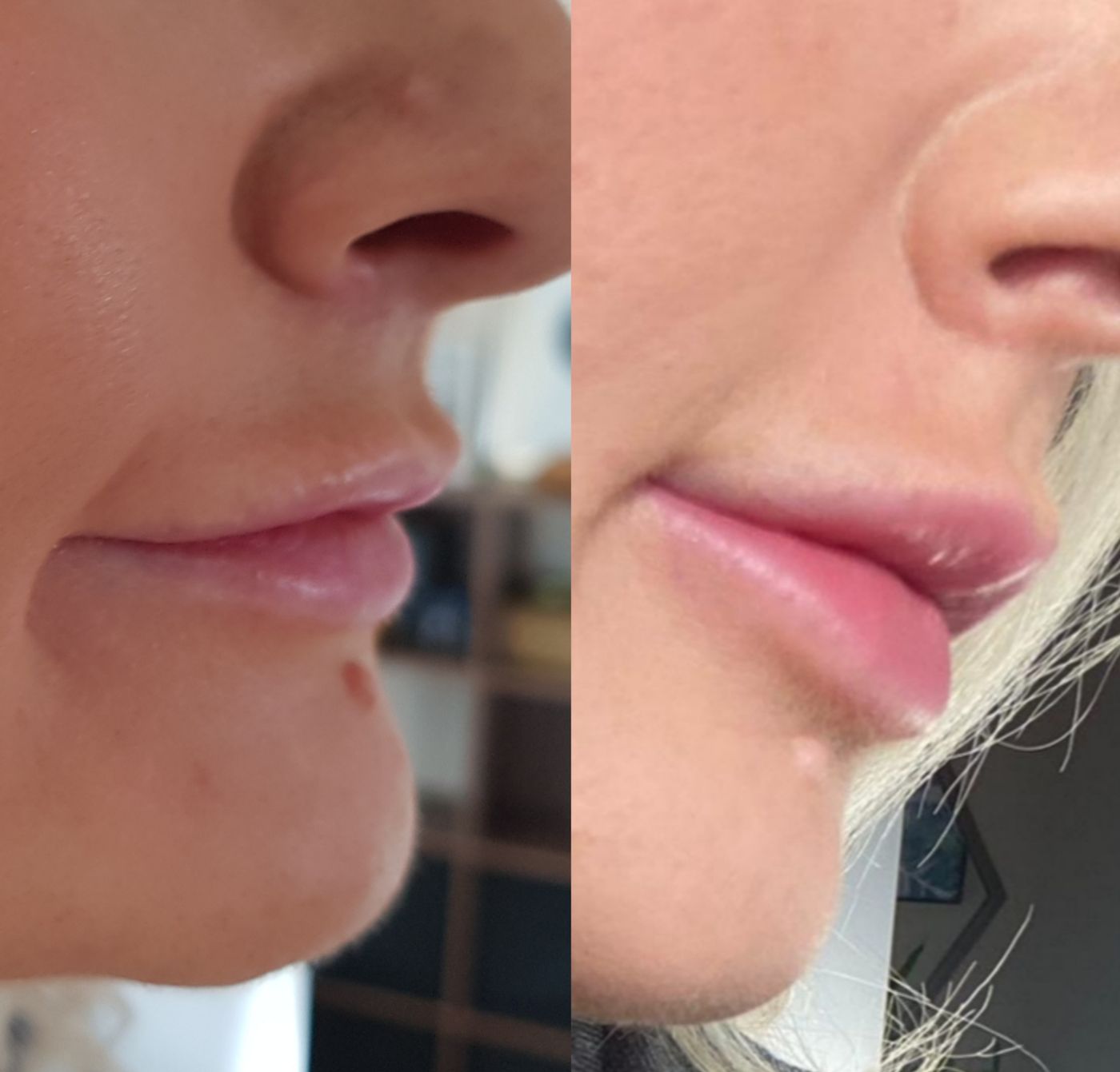 Before and after lips