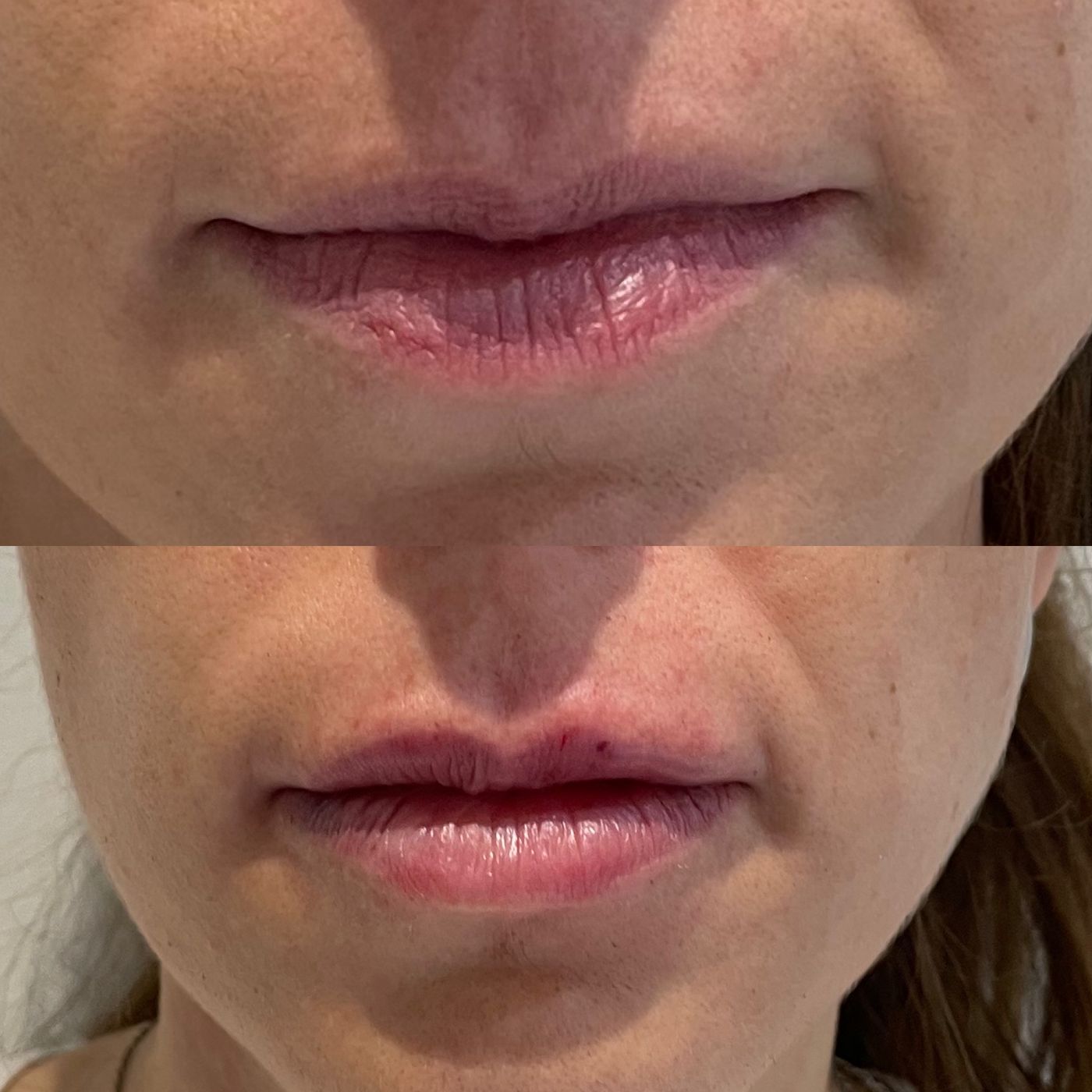 Before and after lips