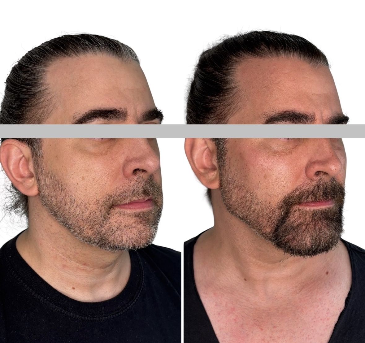 Before and after masculinisation