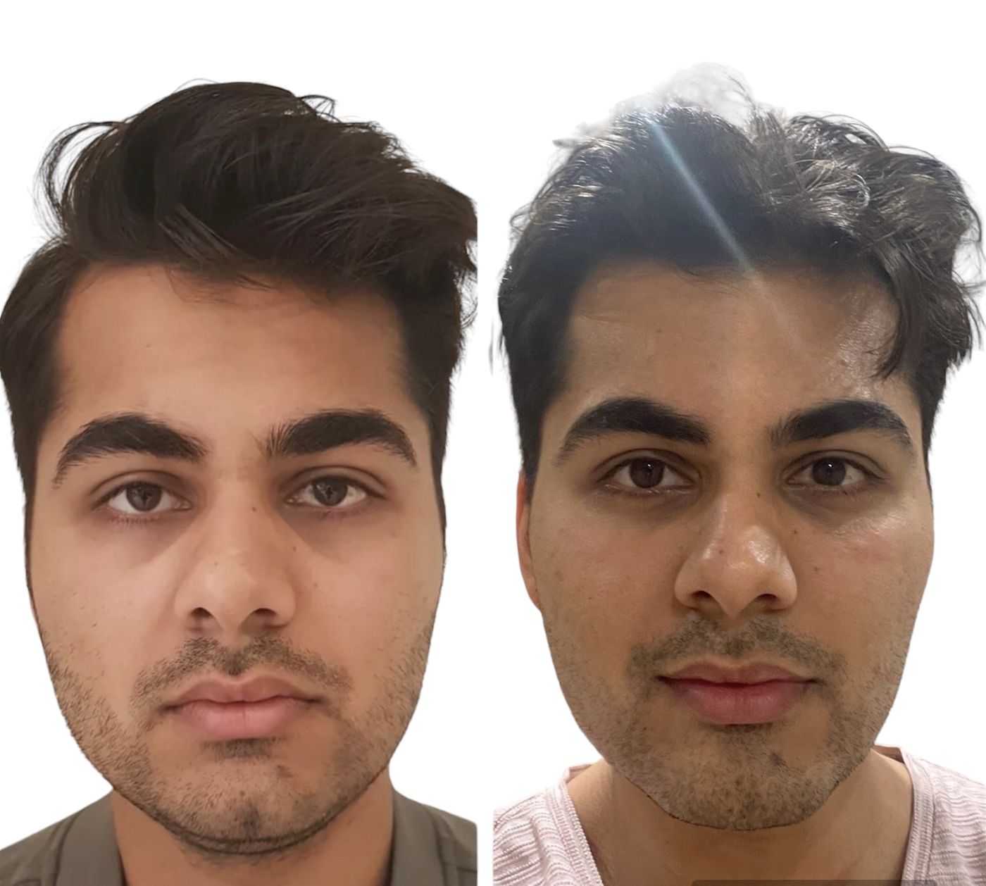 Before and after masculinisation