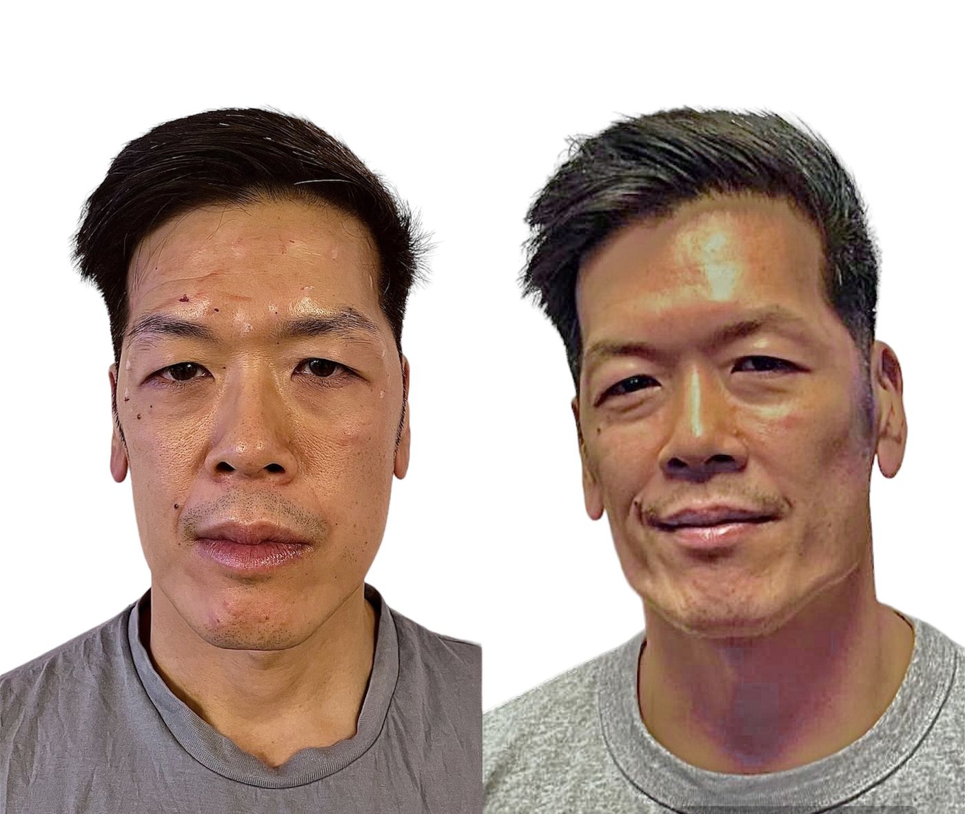 Before and after masculinisation