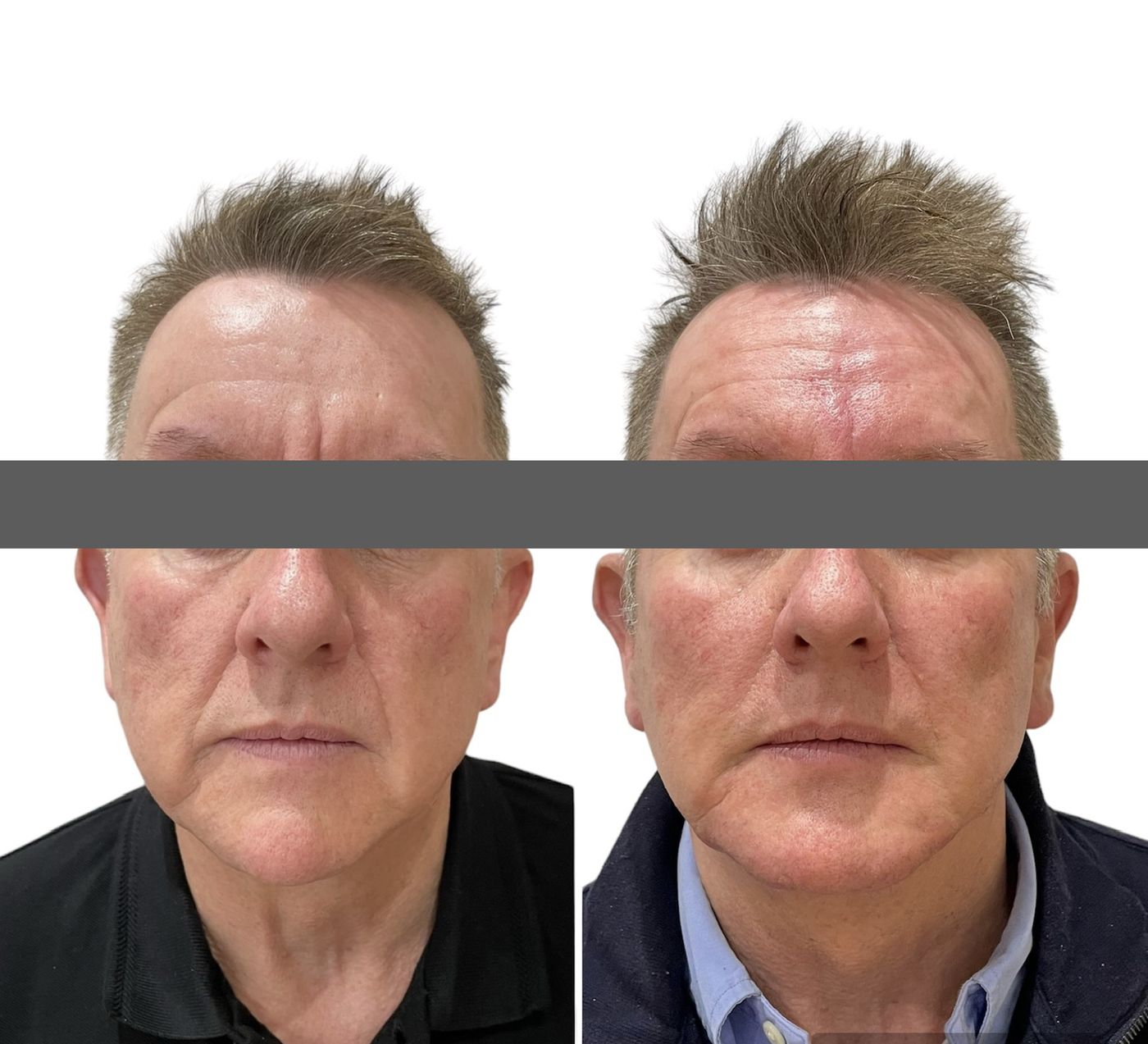 Before and after masculinisation