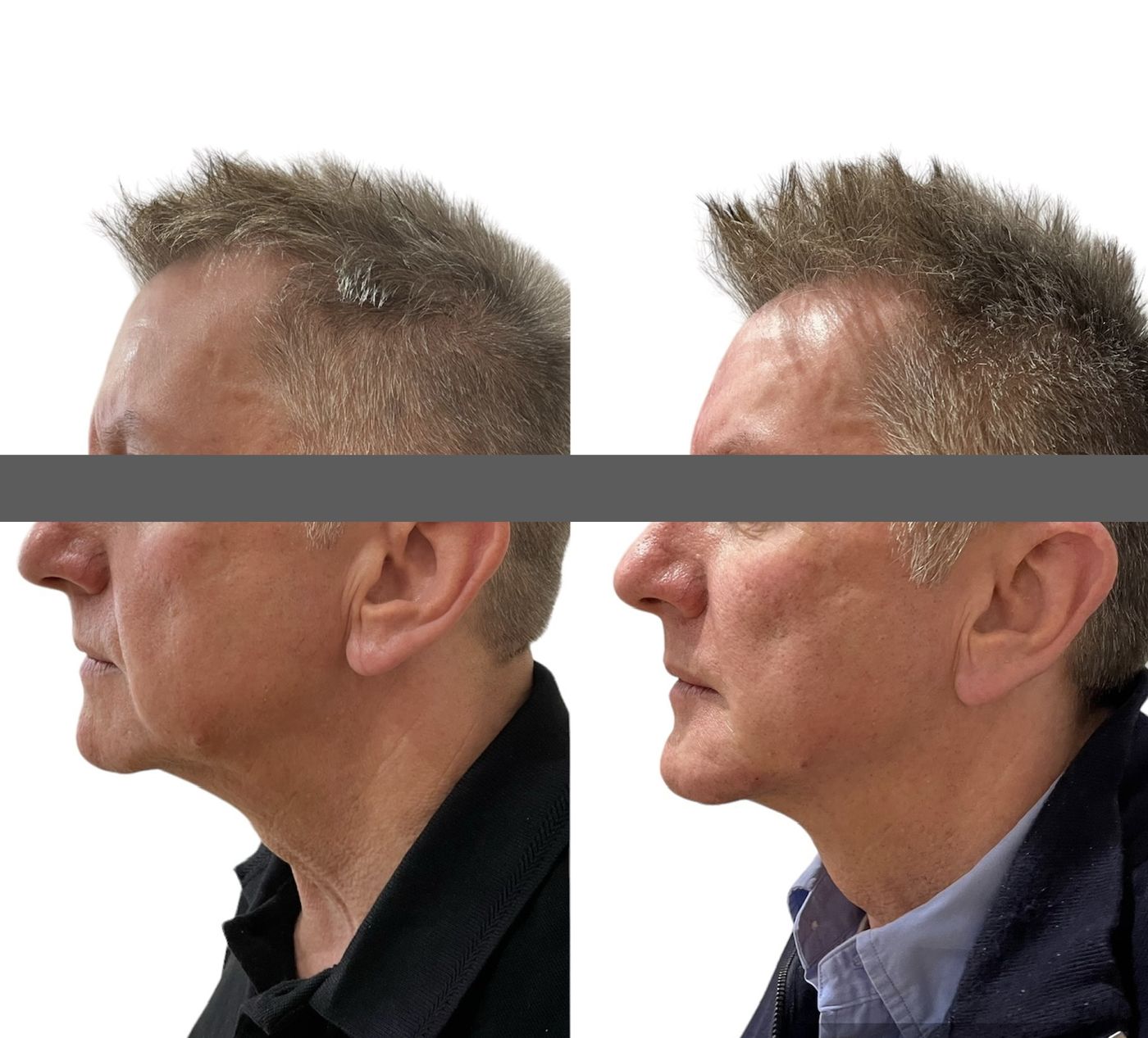 Before and after masculinisation