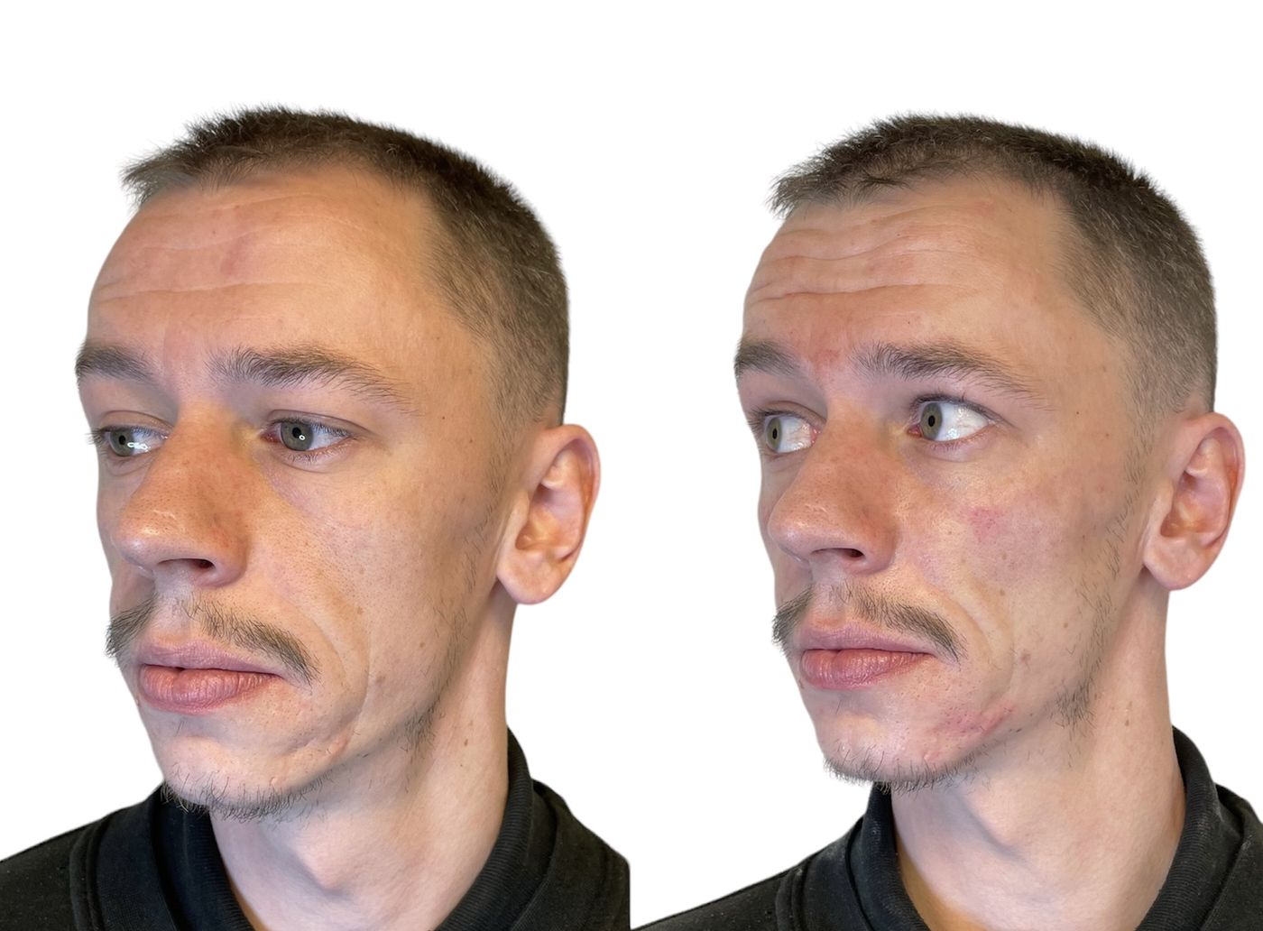 Before and after masculinisation