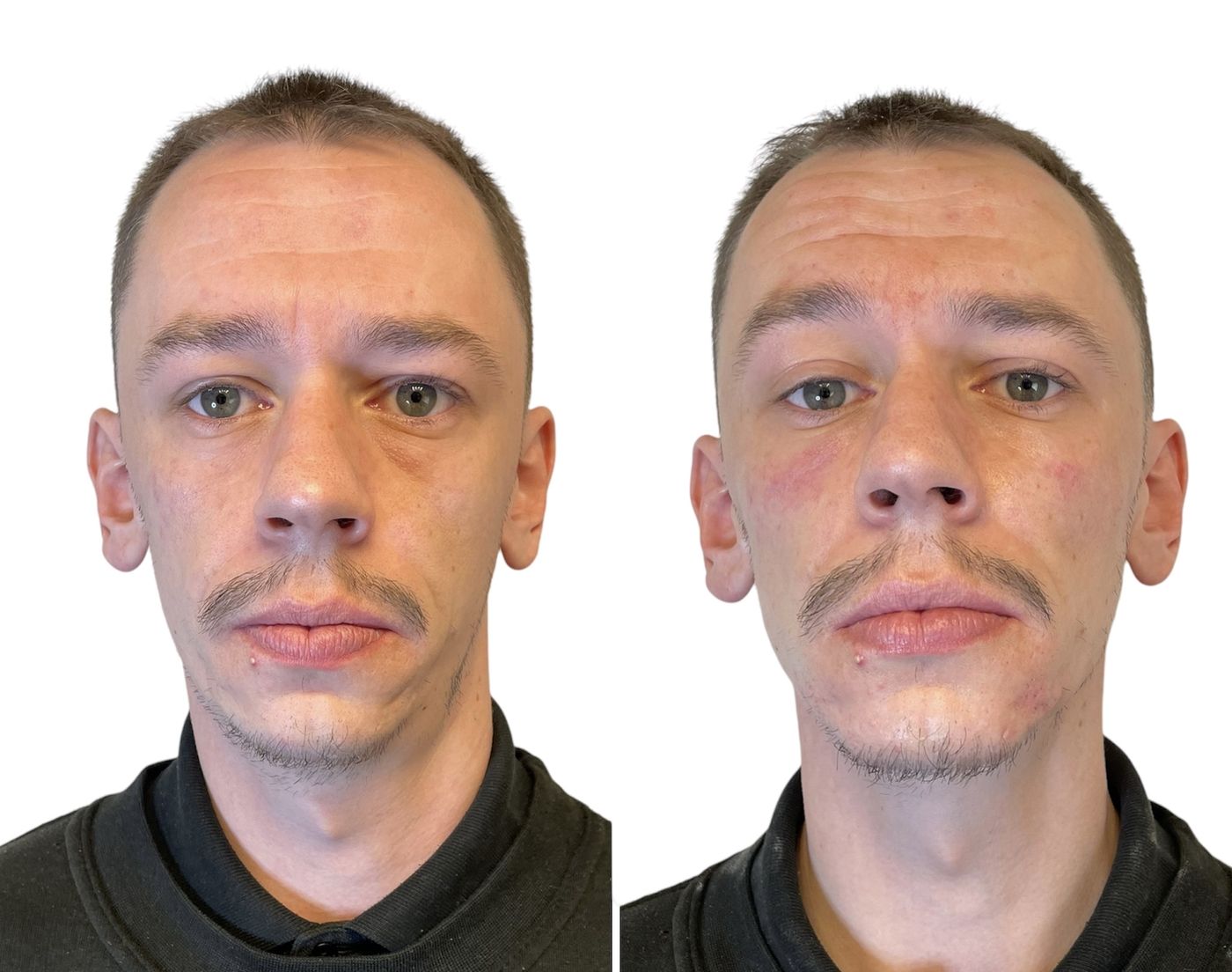 Before and after masculinisation