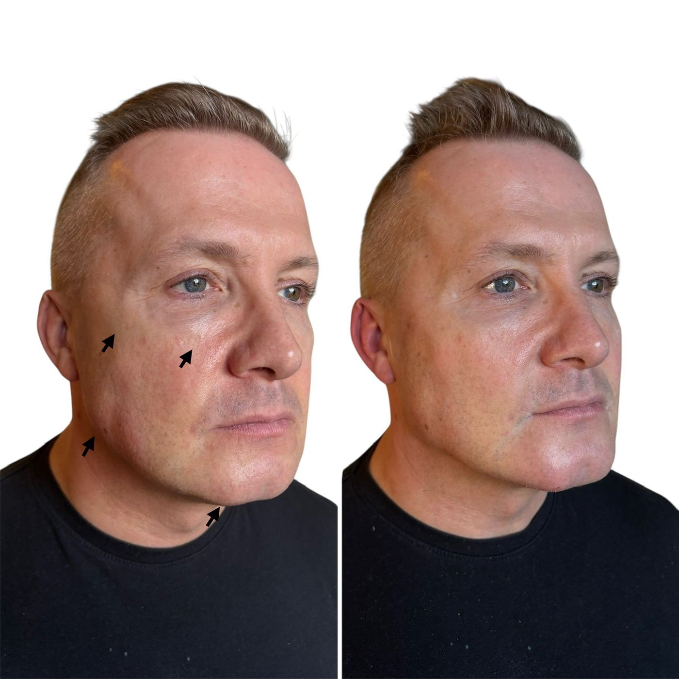 Before and after masculinisation