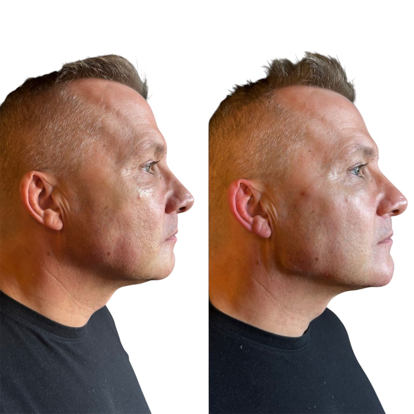 Before and after masculinisation