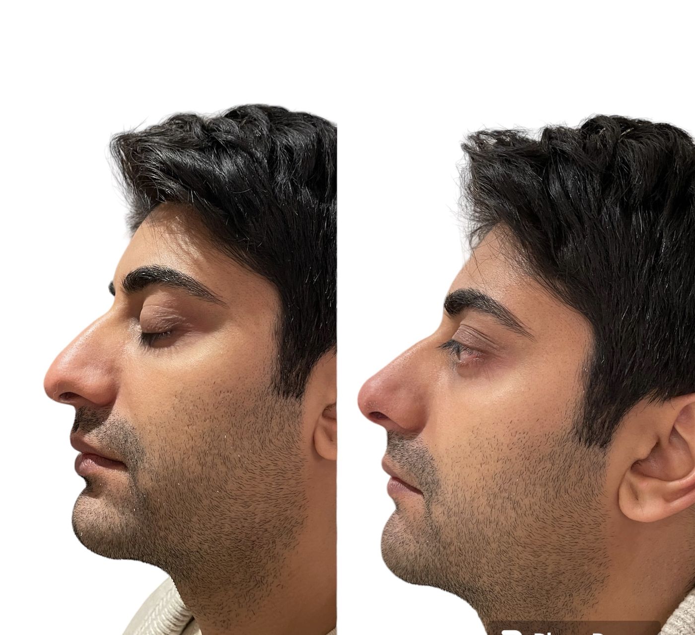 Before and after nose