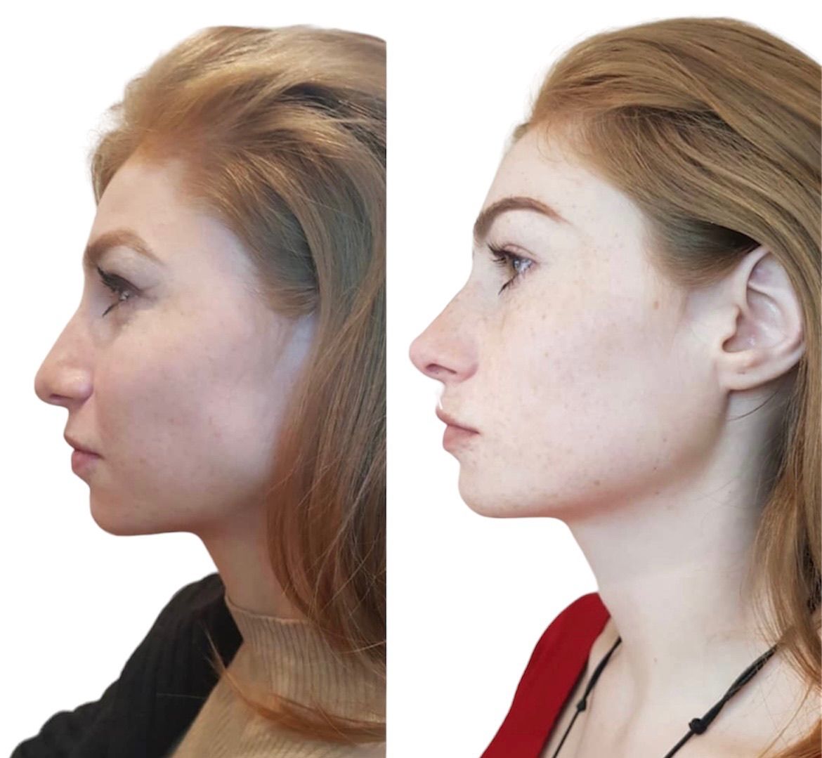 Before and after nose