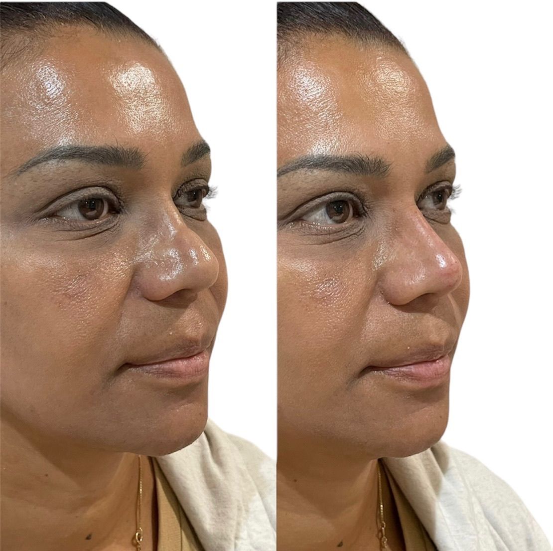 Before and after nose