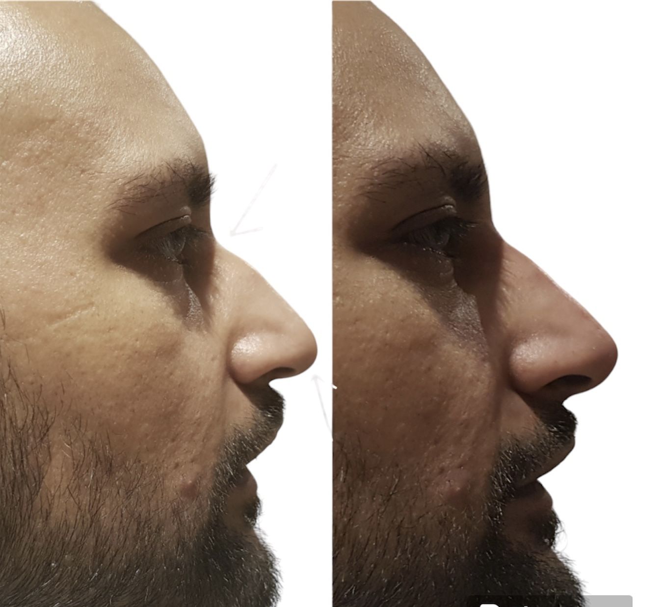 Before and after nose