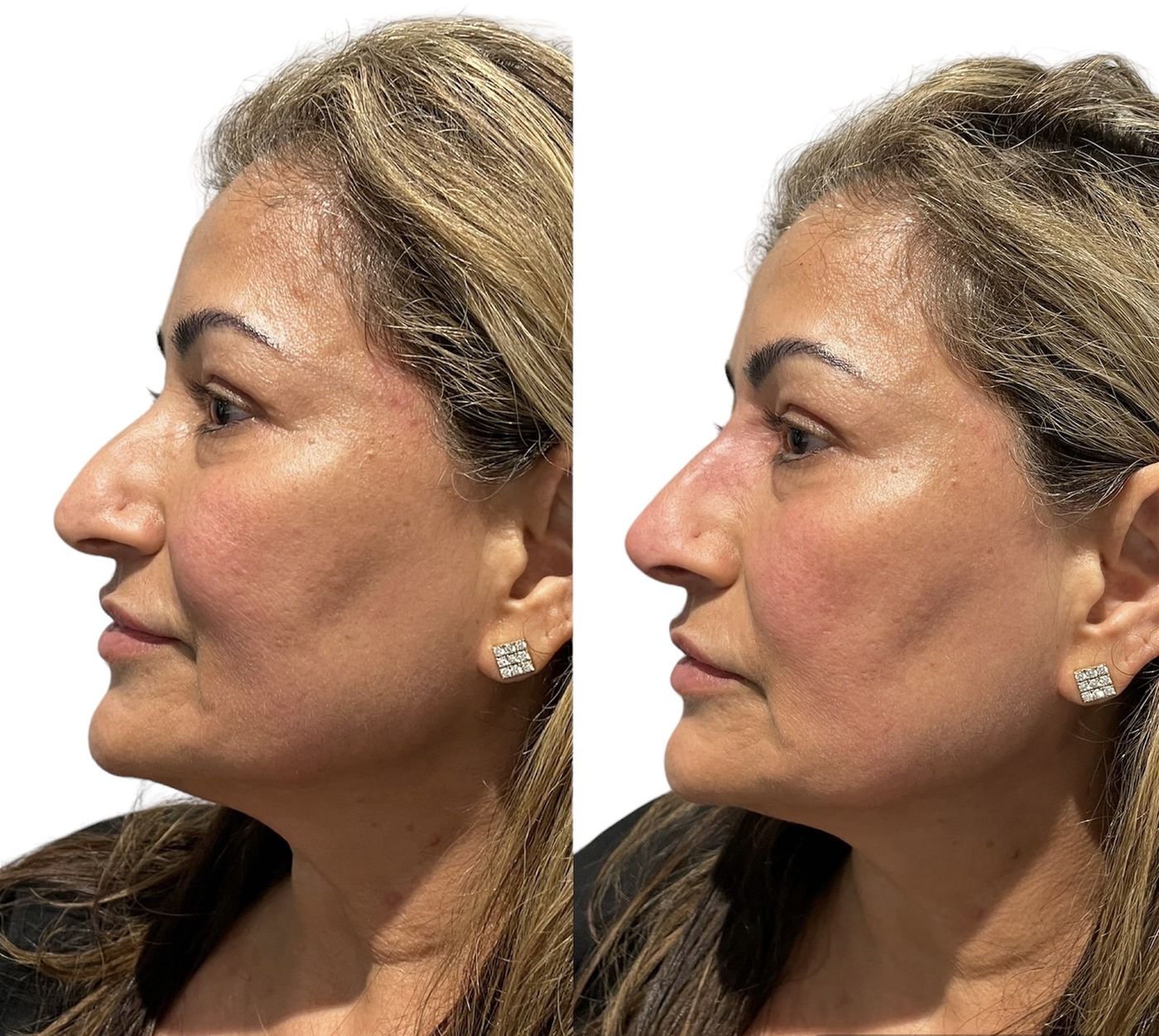 Before and after nose
