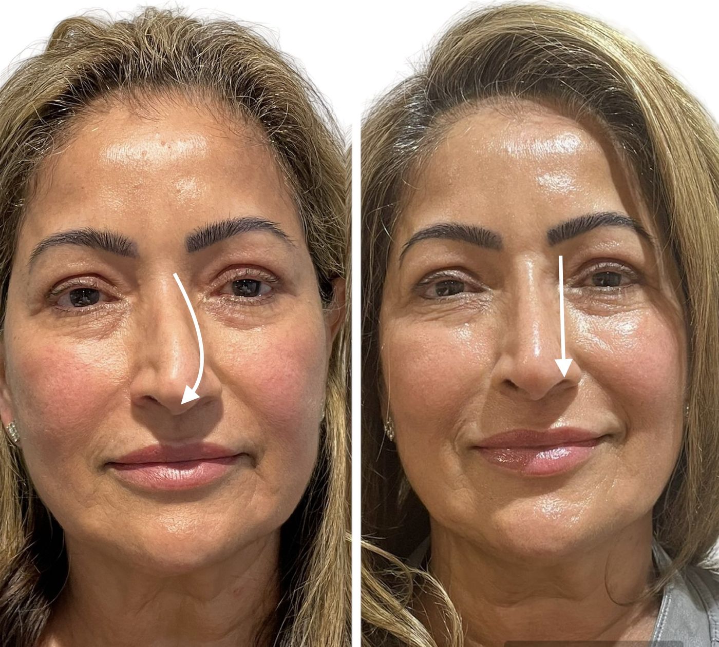 Before and after nose