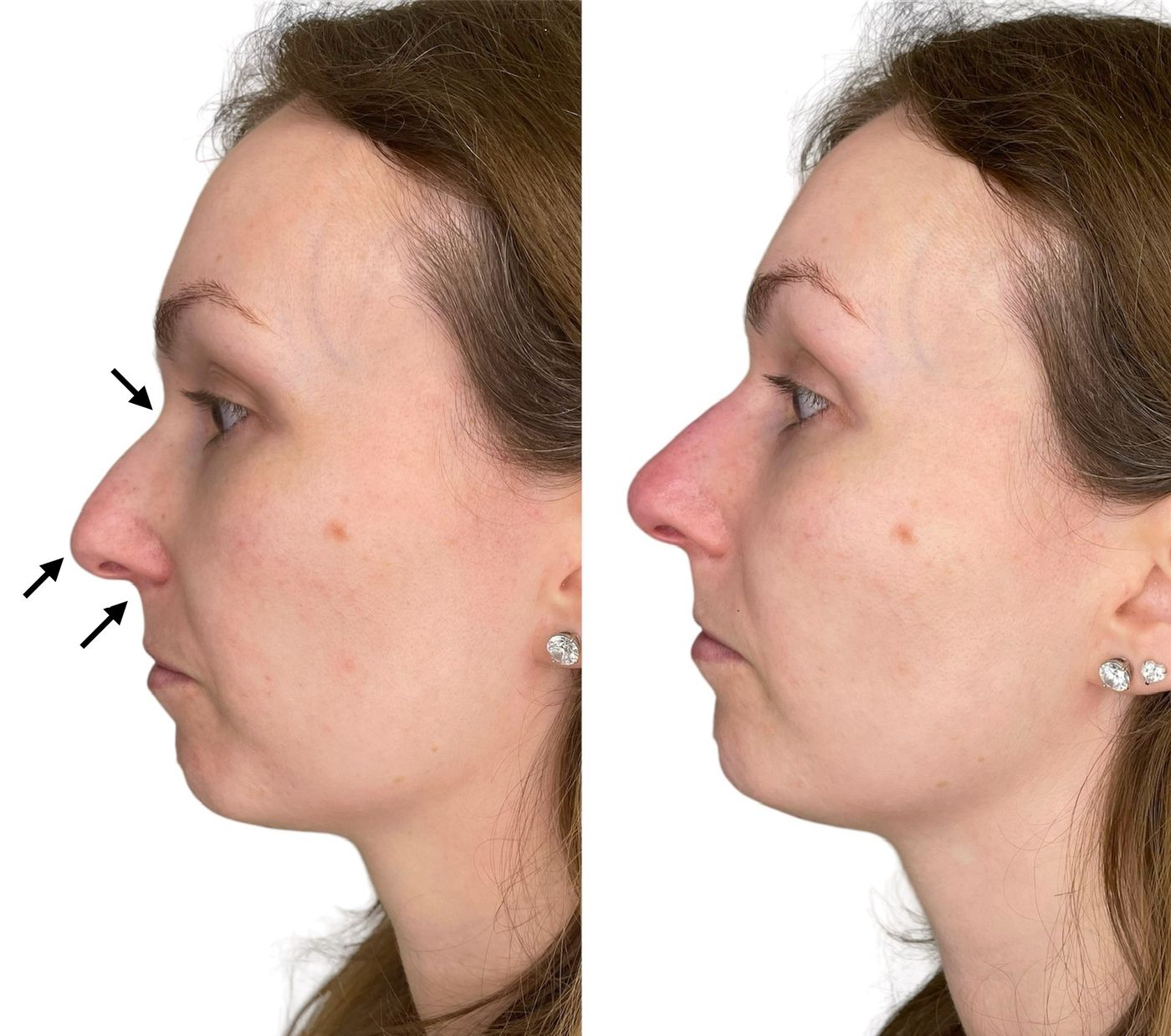 Before and after nose