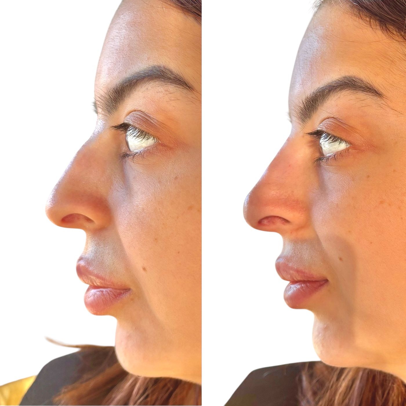 Before and after nose