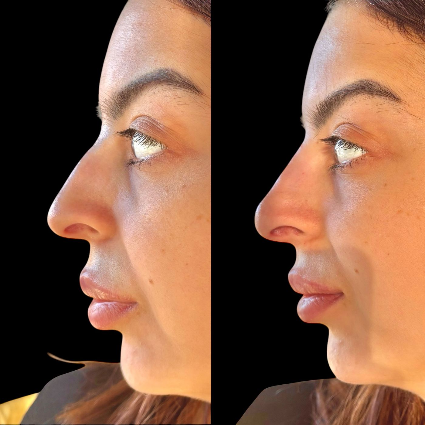 Before and after nose