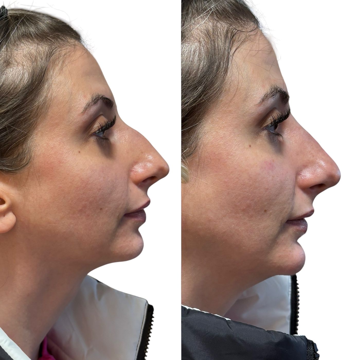Before and after nose